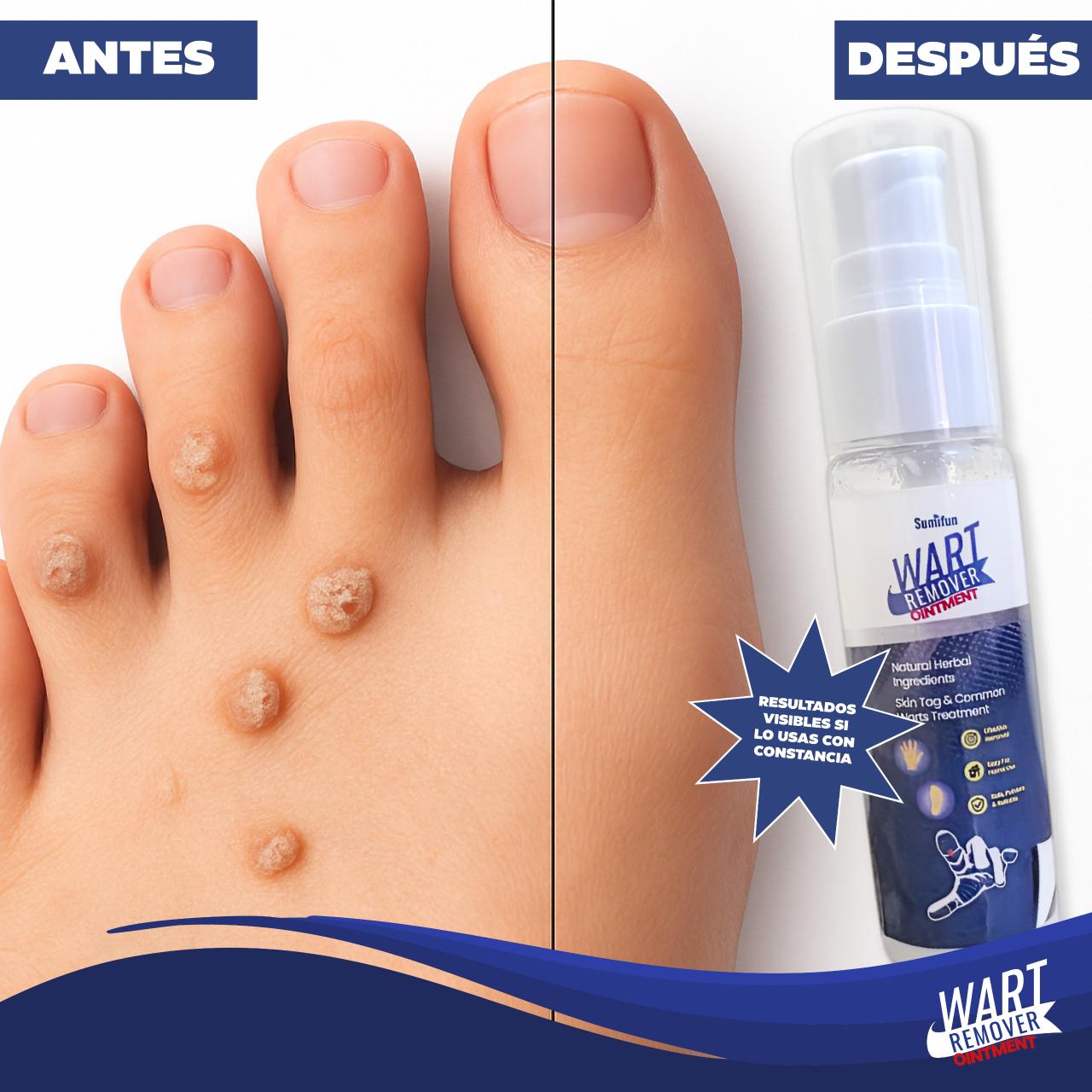 Elimina Verrugas al Instante con Wart Remover Ointment – Piel Suave y Sin Marcas
